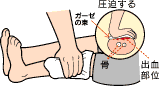 直接圧迫止血法の説明図です